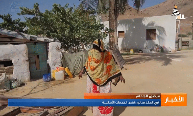 المكلا مرض الجذام